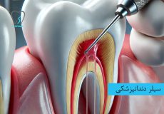 سیلر دندانپزشکی